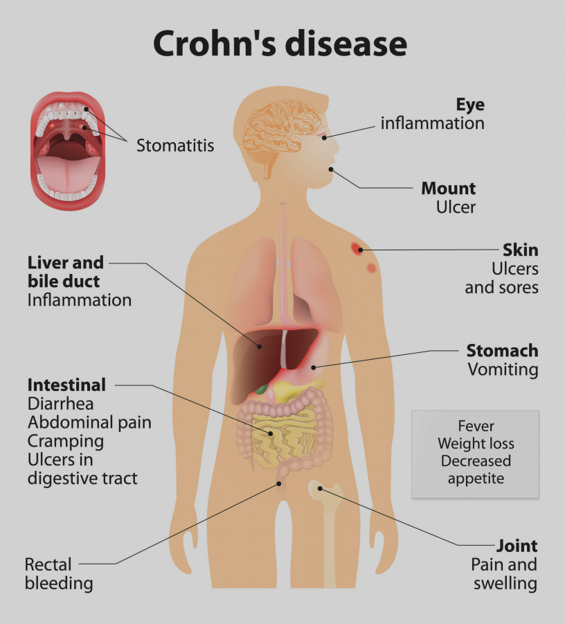 I sintomi della malattia di Crohn