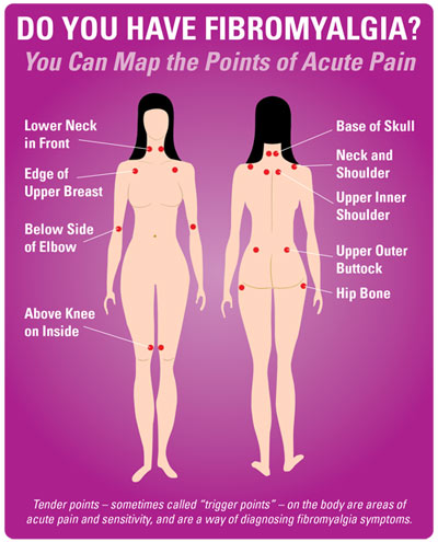 Puntos de activación de la fibromialgia