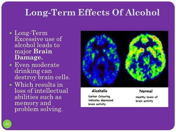 El uso continuado de alcohol causa daños en el cerebro